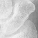 Scaphoid.bmp