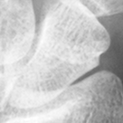Scaphoid.bmp