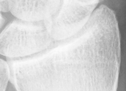 DistalRadius.bmp