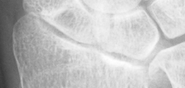 DistalRadius.bmp
