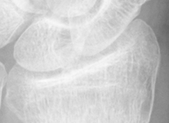 DistalRadius.bmp