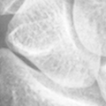 Scaphoid.bmp