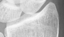 DistalRadius.bmp